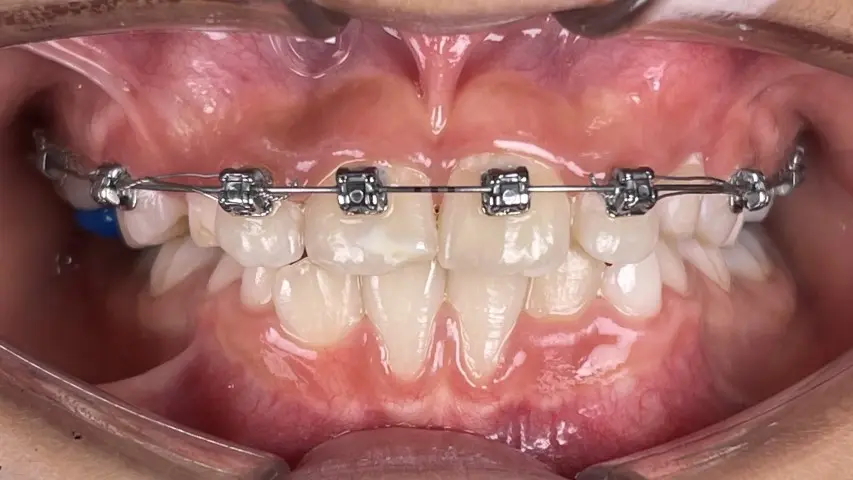 anterior crossbite, treatment with Damon braces