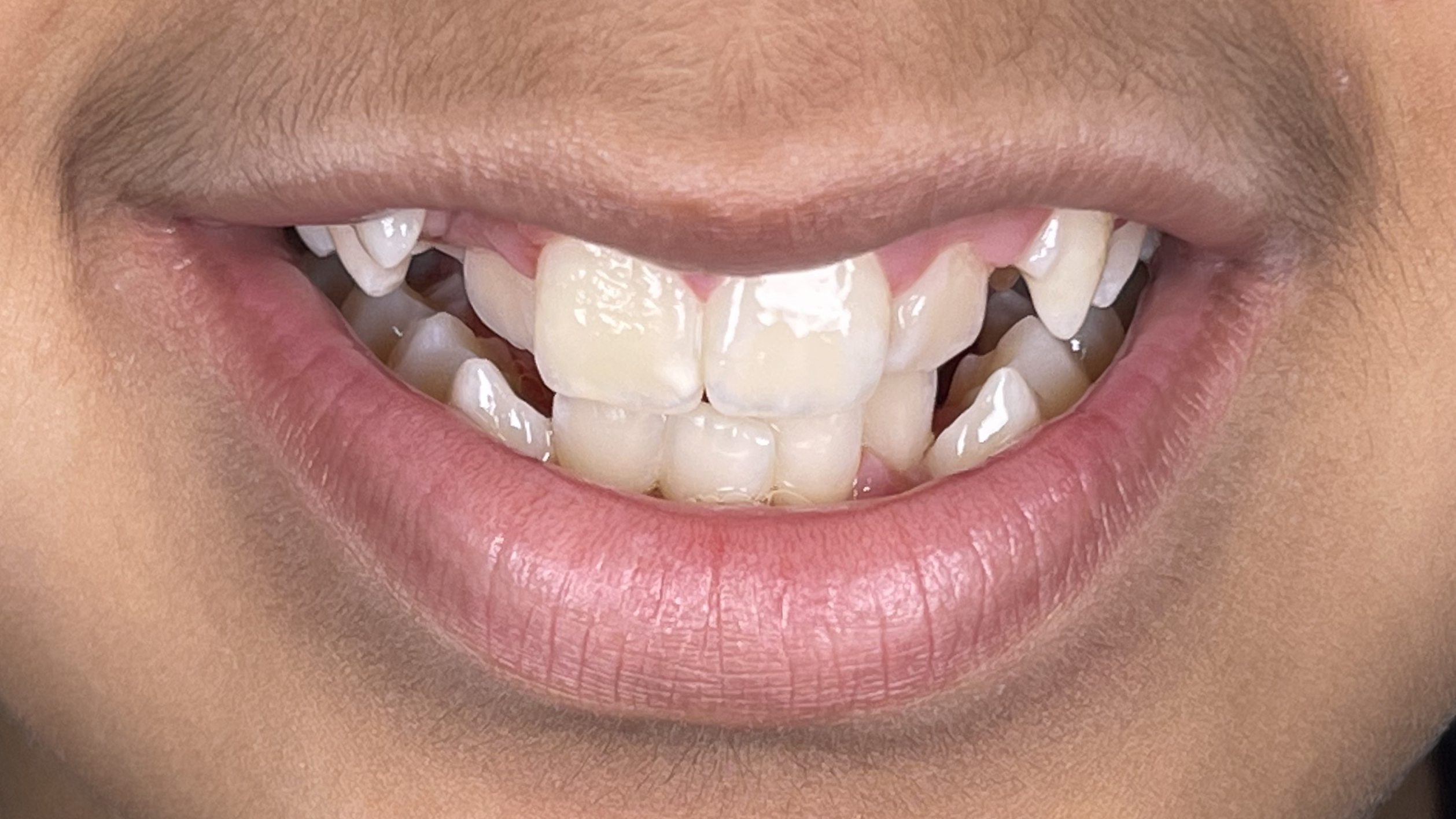 Best Orthodontist In Jumeirah, Dubai 19 dental crowding