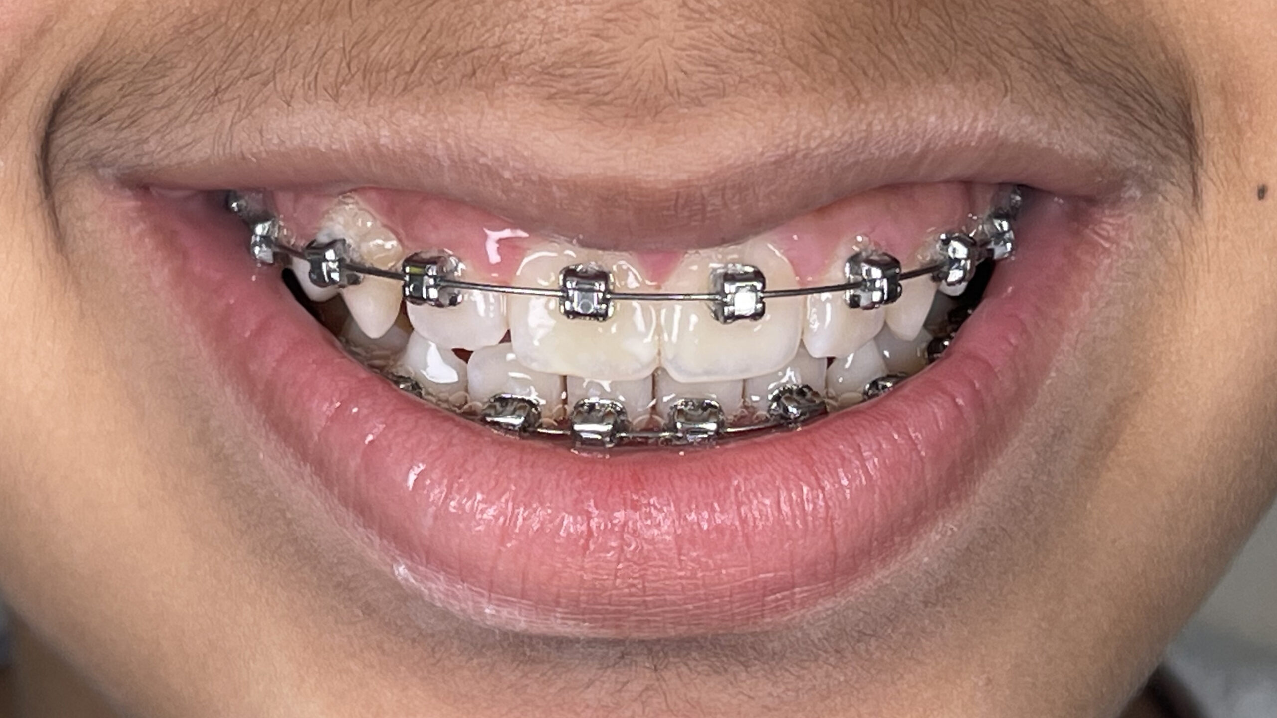 Best Orthodontist In Jumeirah, Dubai 18 kids braces after result