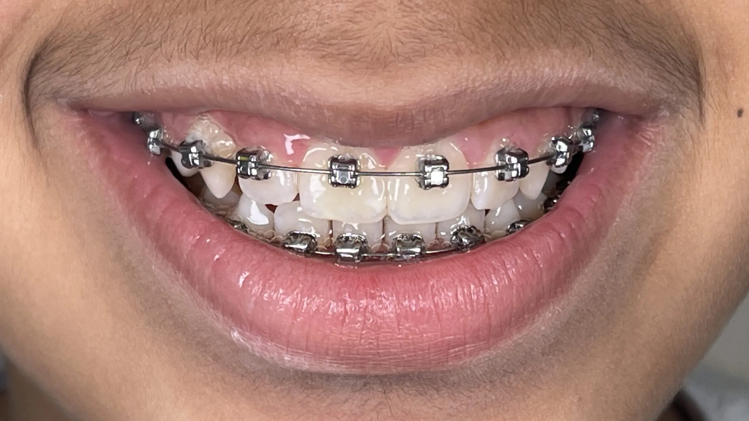 kids braces after result
