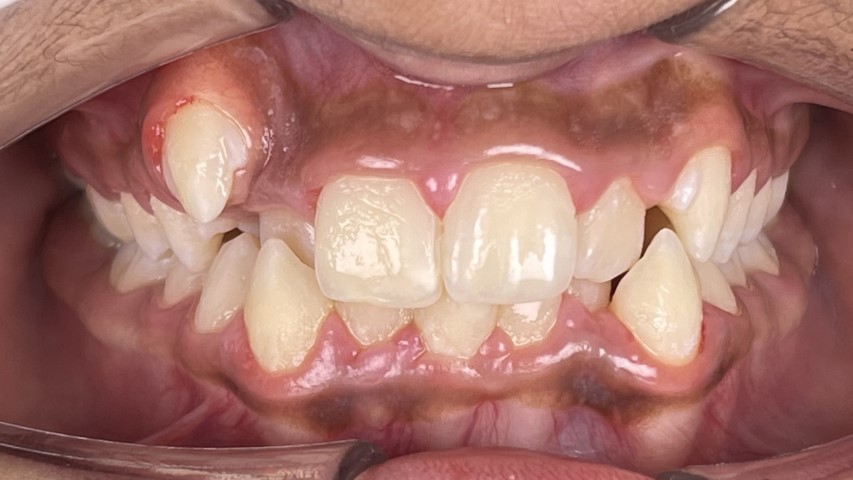 dental crowding