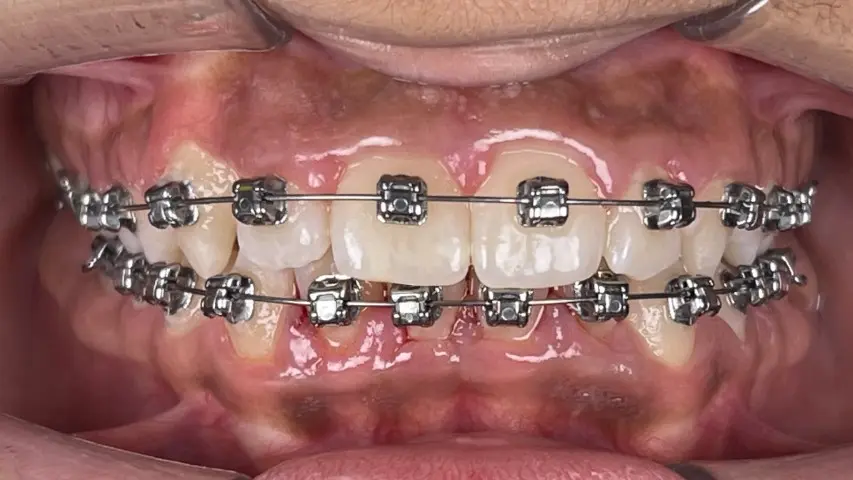 treatment with Damon braces