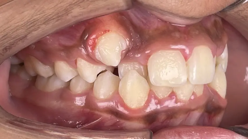 dental crowding before braces