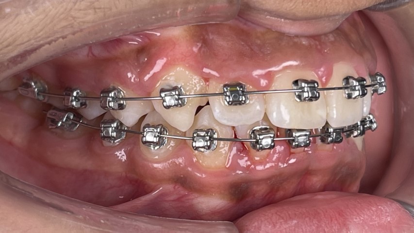 treatment with Damon braces