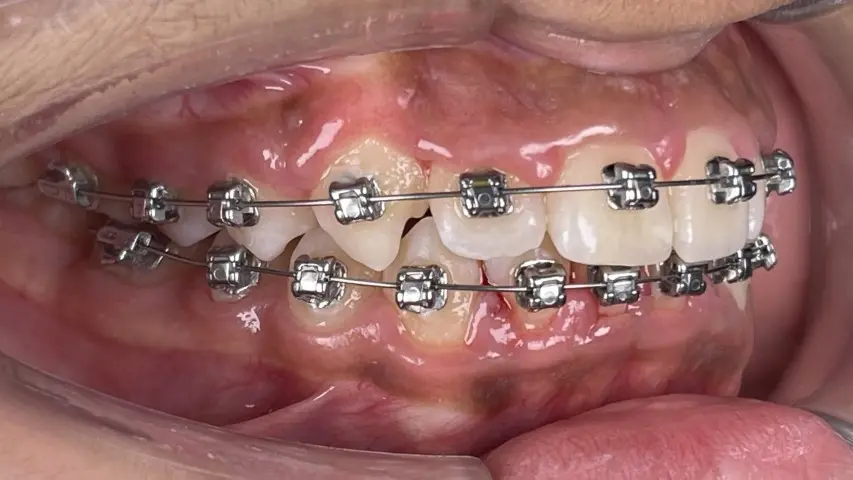 treatment with Damon braces