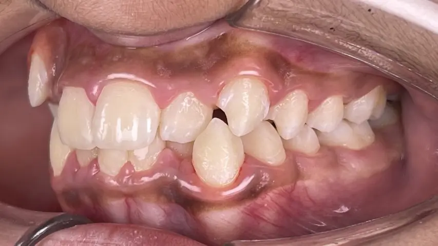 dental crowding before image