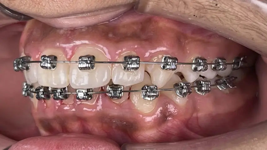 dental crowding treatment with Damon braces