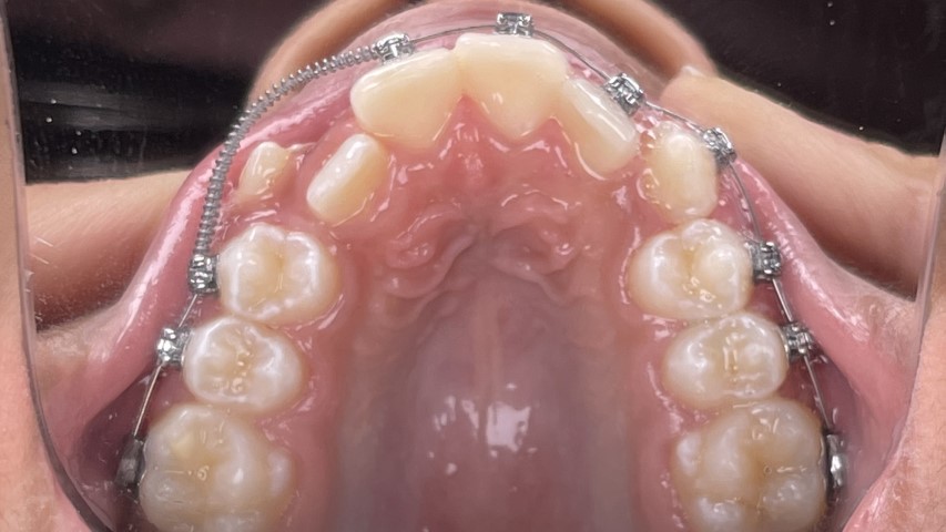 dental crowding