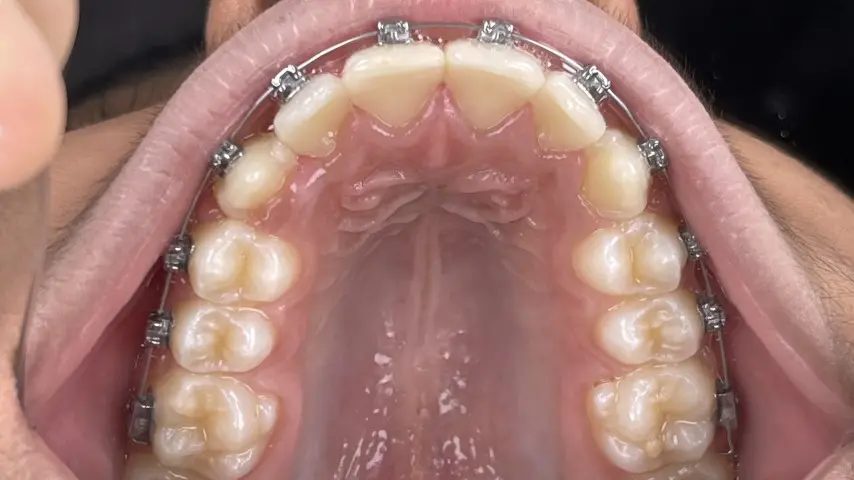 treatment with Damon braces after result