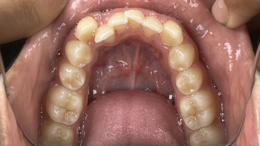 dental crowding