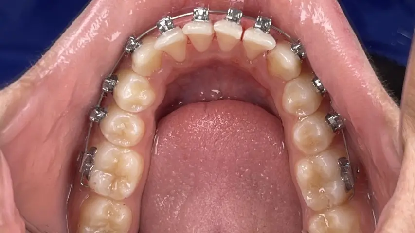 treatment with Damon braces