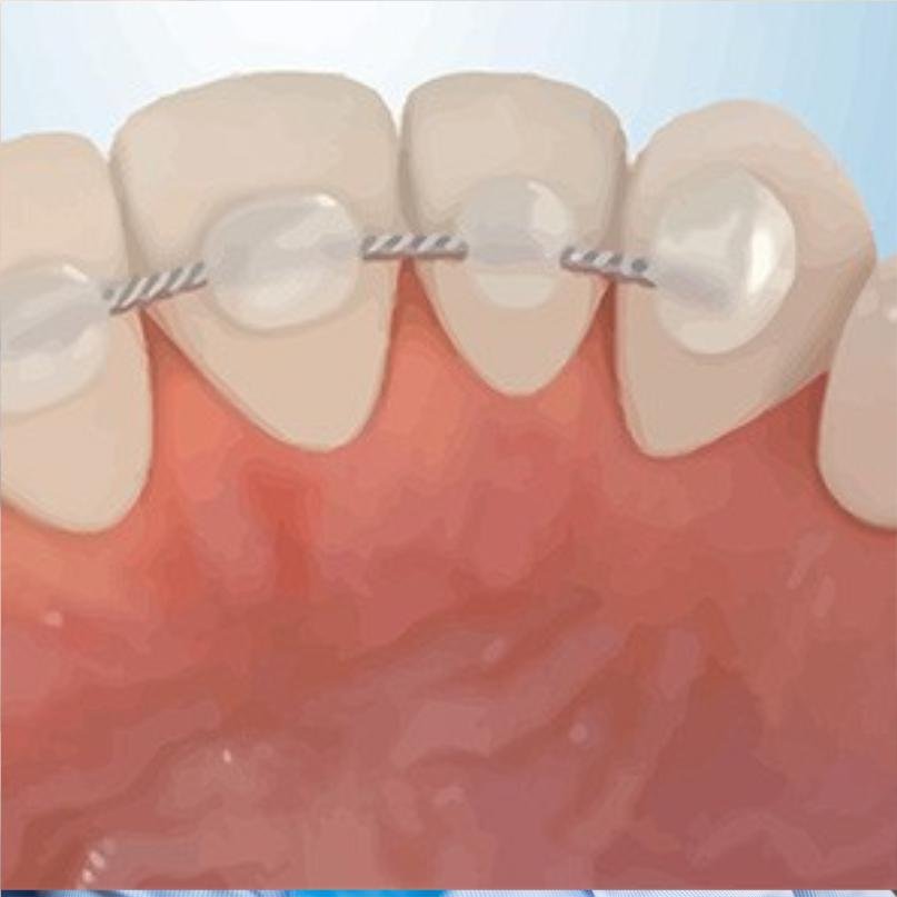 Ceramic Braces 8 Ceramic Braces Before and After
