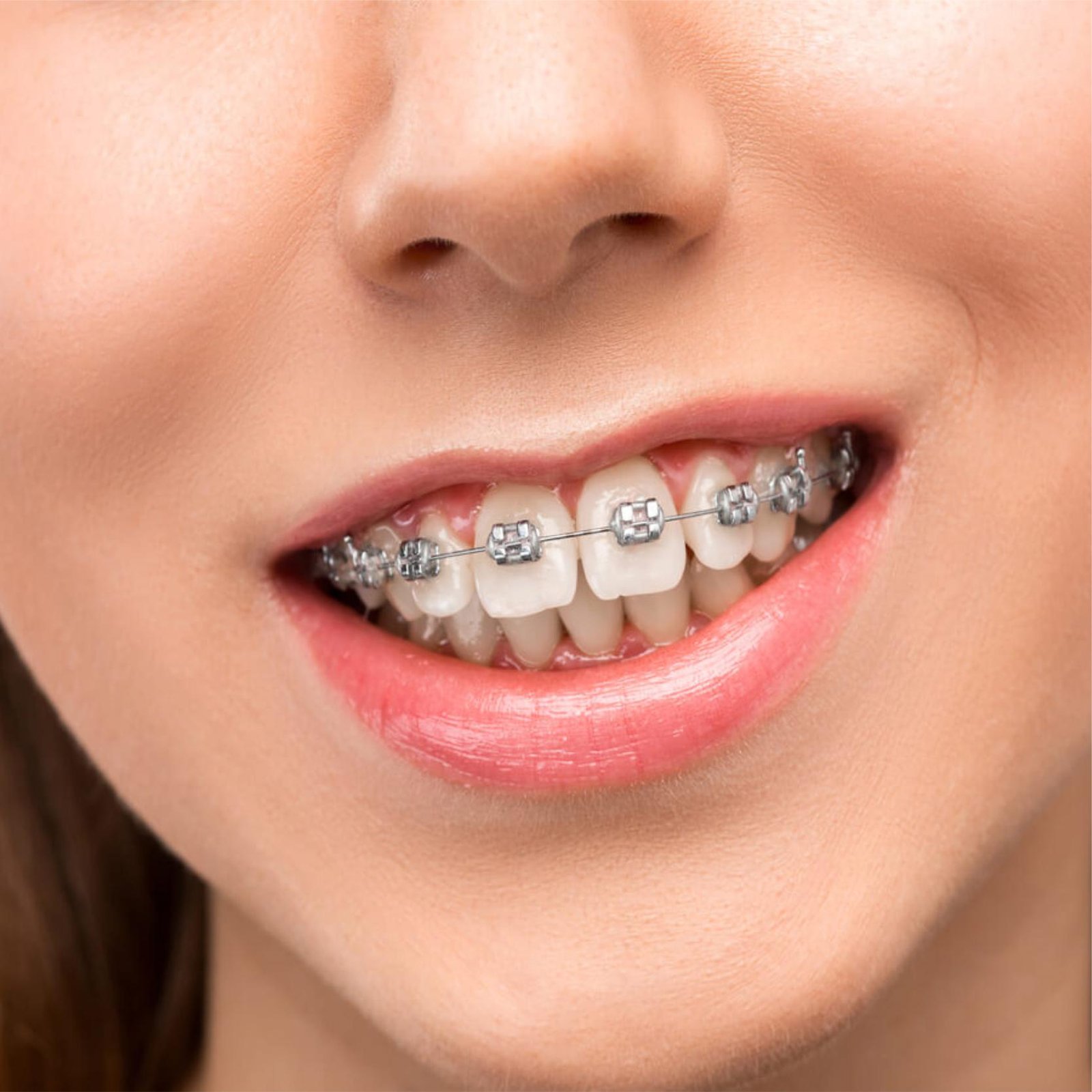 Damon Braces 6 Damon Braces Orthodontist near me