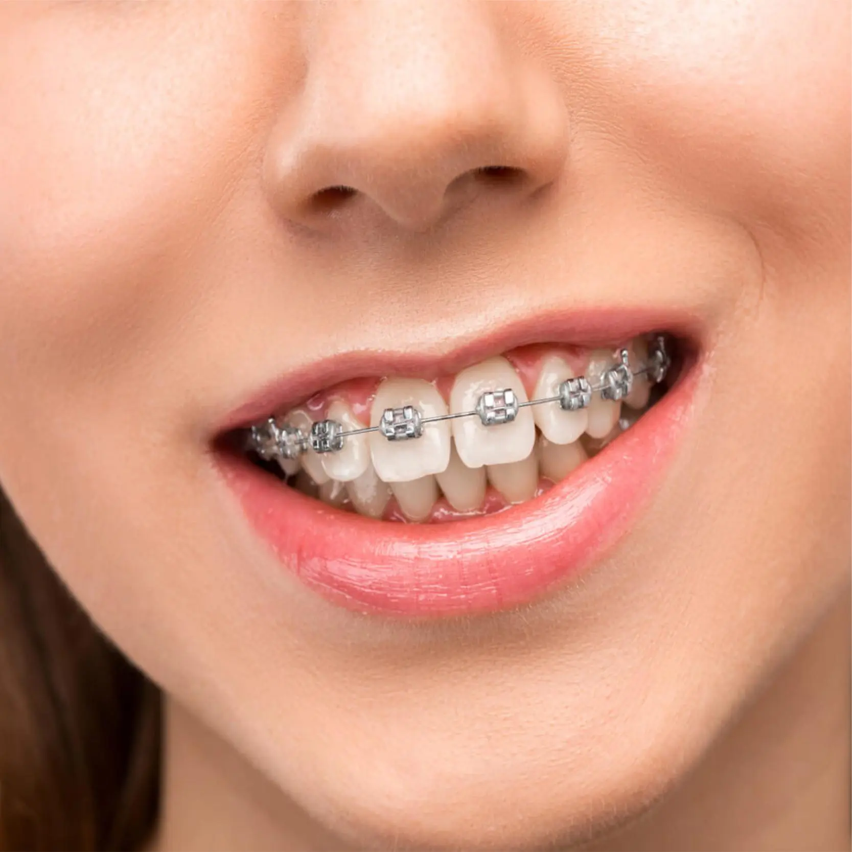 Damon Braces 6 Damon Braces Orthodontist near me