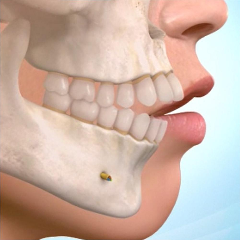 Orthognathic Surgery Cost