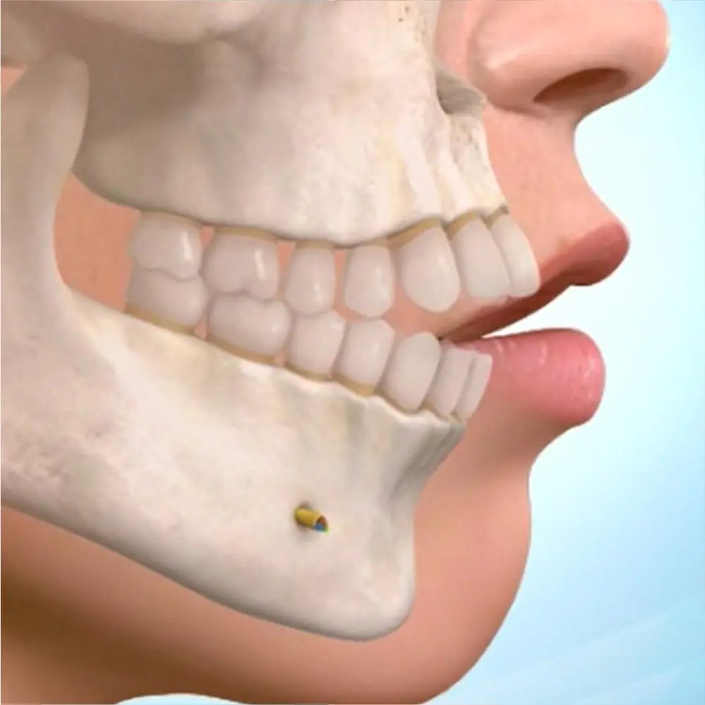 Orthognathic Surgery Cost