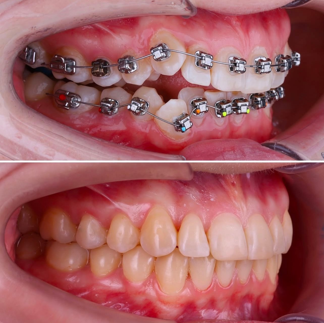 Metal Braces Dubai 9 Braces Metal
