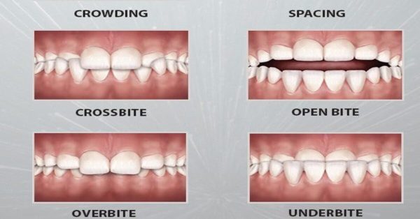 Common Orthodontic Problems: Types, Causes & Treatment Options