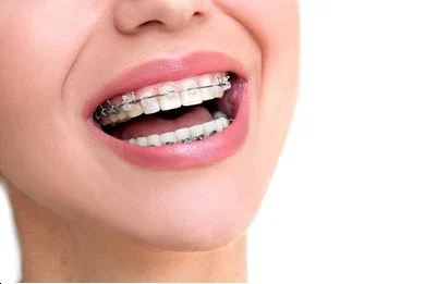 Ceramic Braces 7 Damon braces clear braces near me