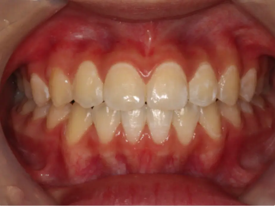 over biting treatment with Invisalign, spark aligner