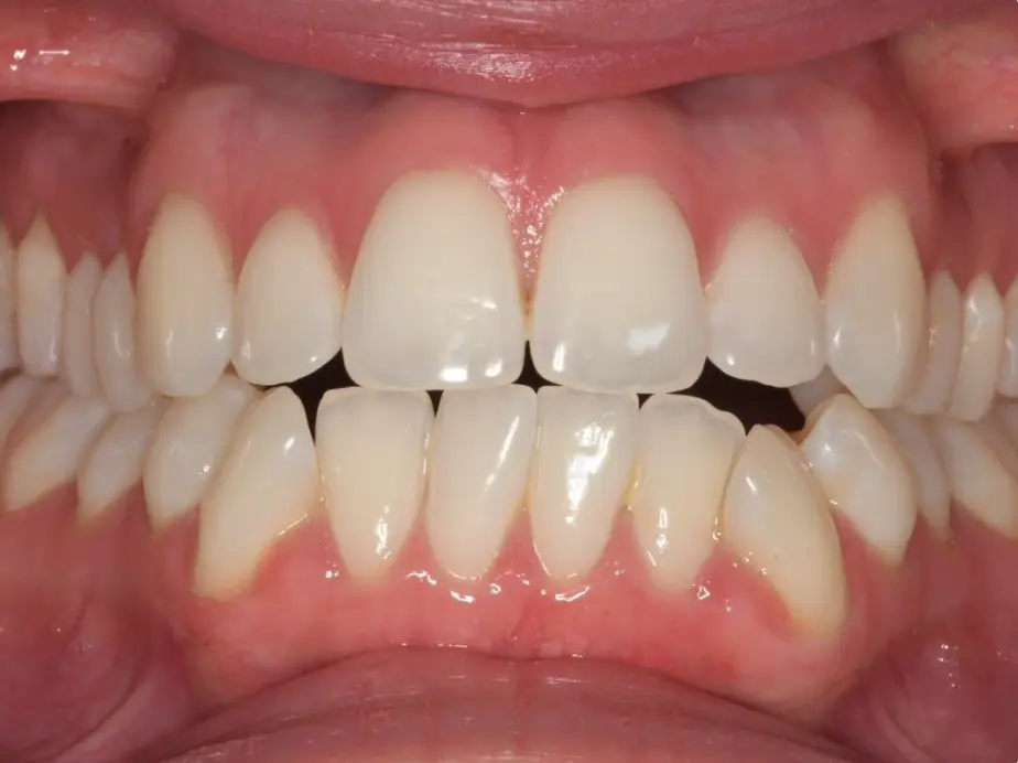 Best Orthodontist In Jumeirah, Dubai 23 dental crowding