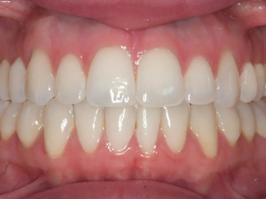 Best Orthodontist In Jumeirah, Dubai 22 open bite