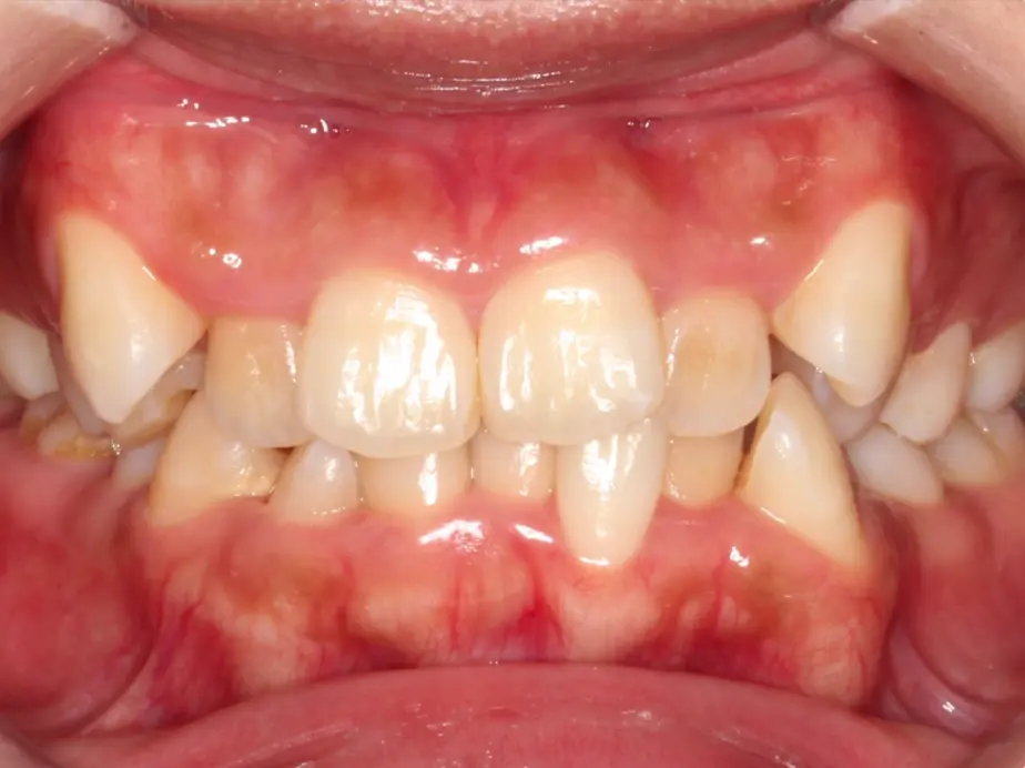 Best Orthodontist In Jumeirah, Dubai 25 severe crowding