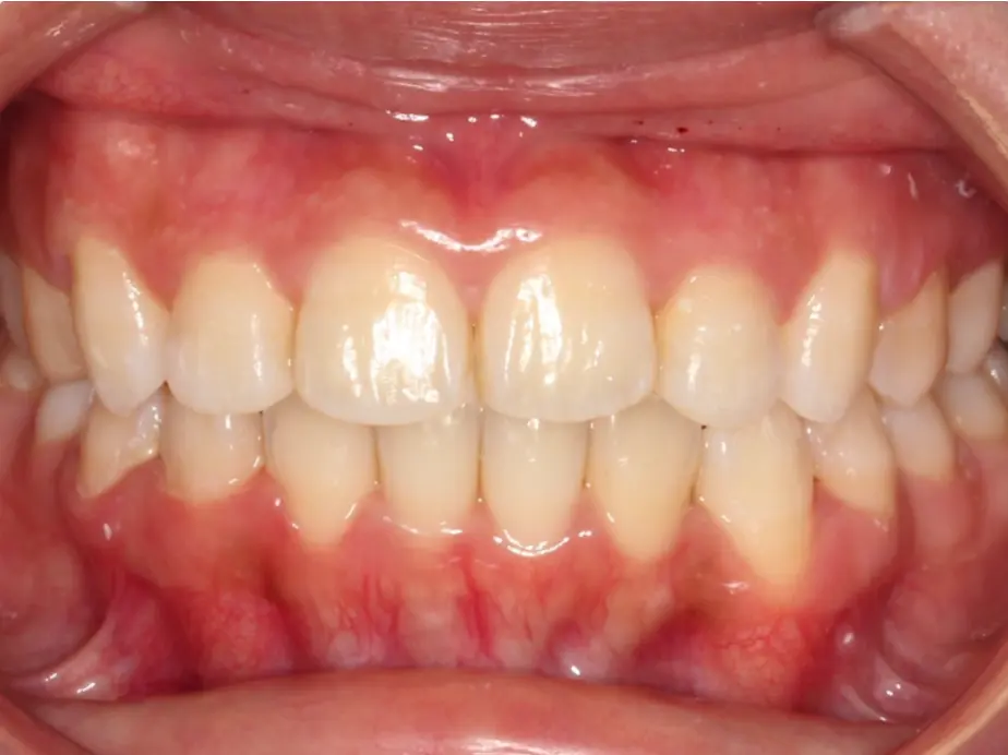Best Orthodontist In Jumeirah, Dubai 24 tooth extraction