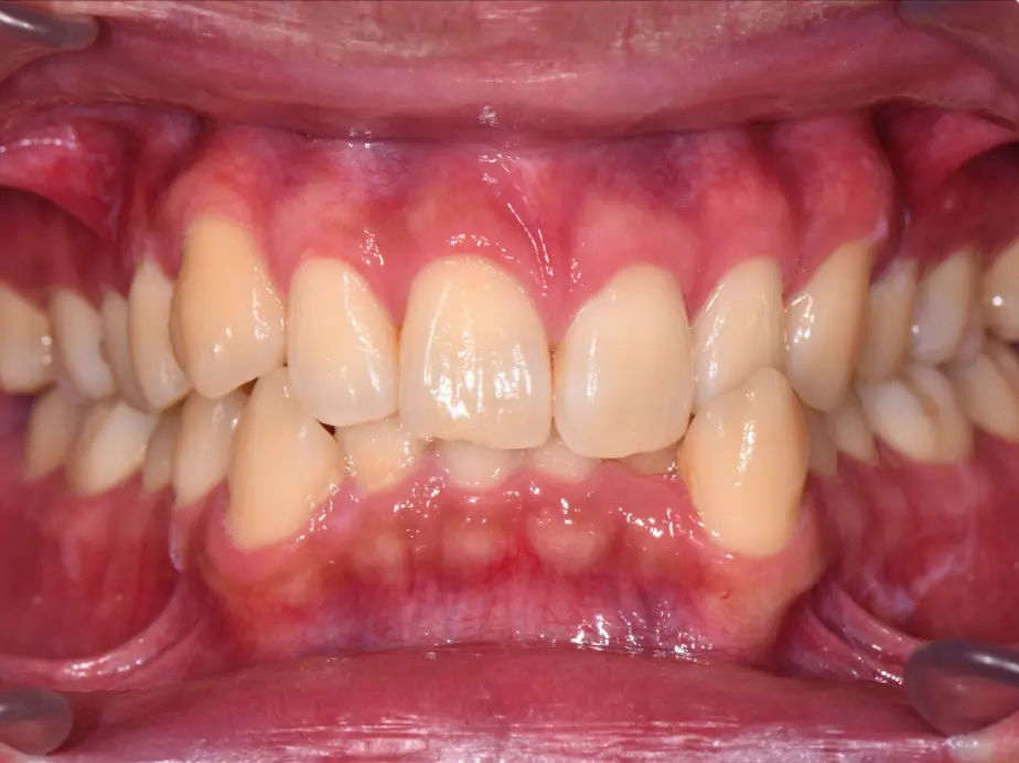 Best Orthodontist In Jumeirah, Dubai 27 dental crowding
