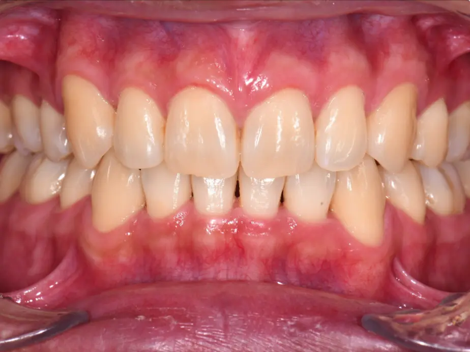Best Orthodontist In Jumeirah, Dubai 26 blocked-out tooth