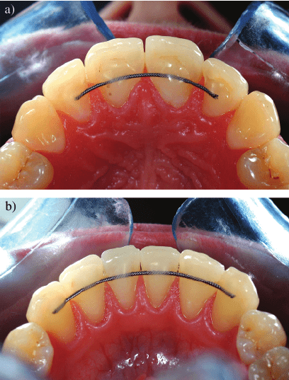 Permanent retainer near me