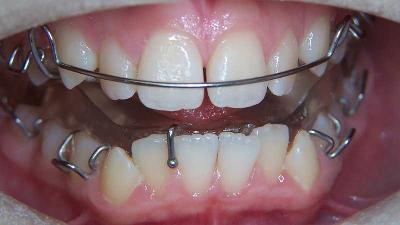 Twin Block Braces 4 Twin Block Appliance uses