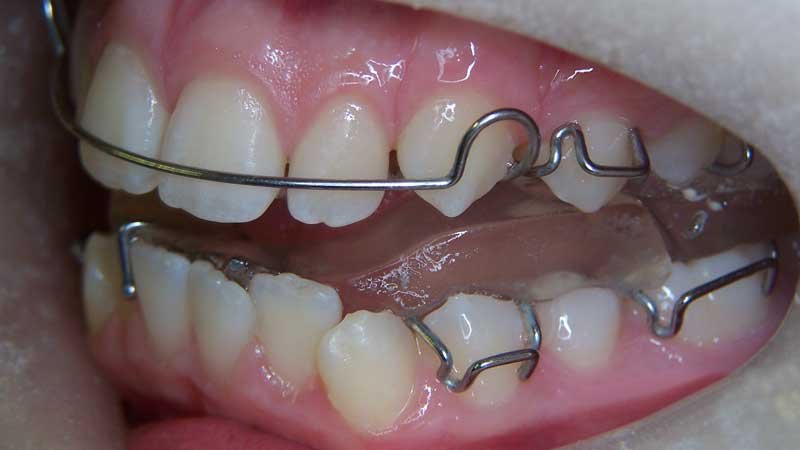 Twin Block Braces 5 Twin Block Appliance Indications