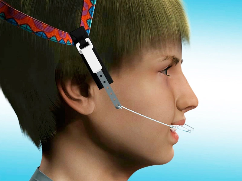 Orthodontic Headgear, Jumeirah Dubai 6 headgear