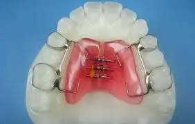 Palatal Expander 6 palatal expander before and after