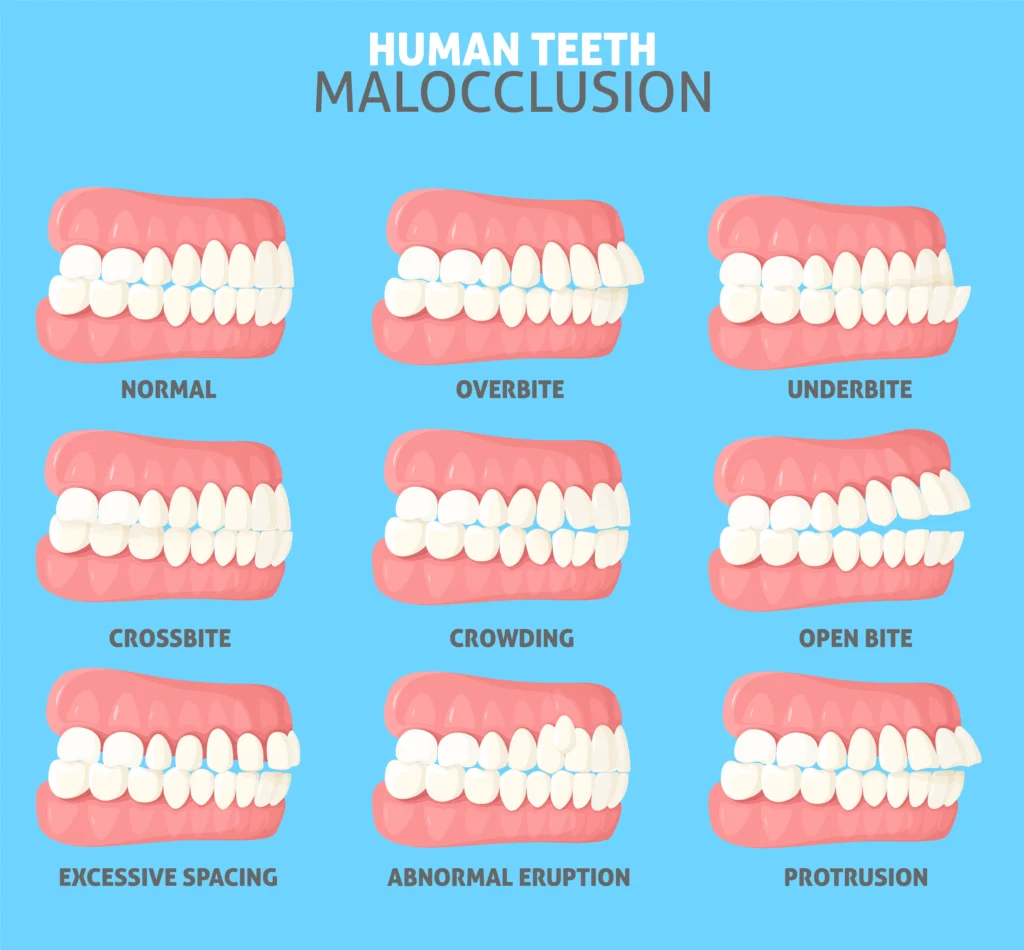 Can Orthodontic Problems Affect Your Speech? 1 Orthodontic Problems Affect Your Speech