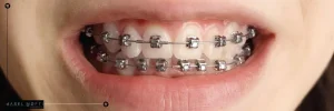 Self ligating Braces