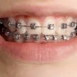 Self-Ligating Braces