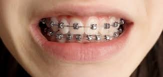 Self Ligating Braces – The Modern Orthodontic Marvel image
