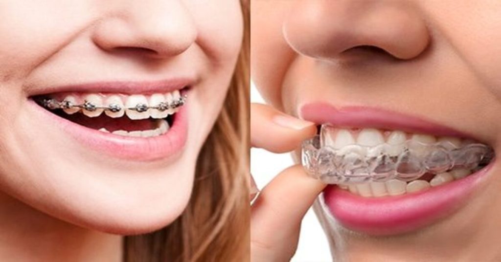 Braces vs Invisalign