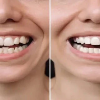 Traditional Braces vs. Clear Aligners:Which Smile Solution Is Right For You? 10 Braces vs Invisalign