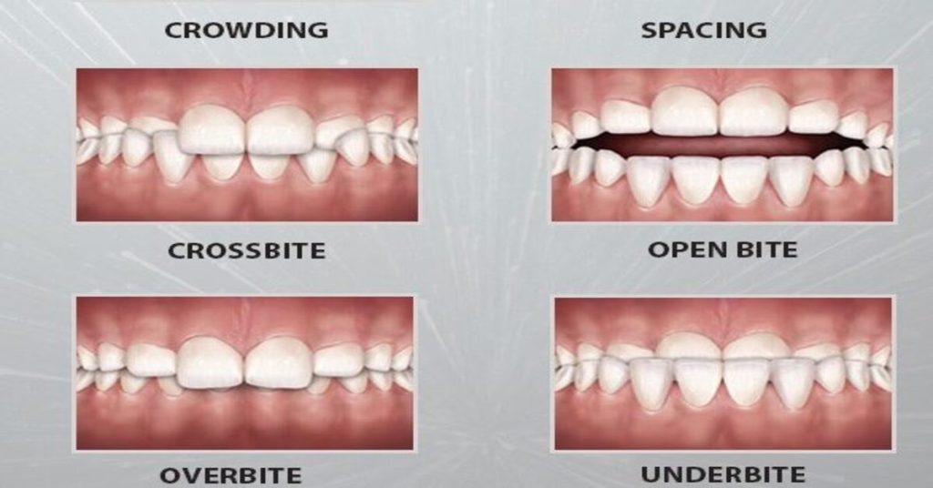 Common Orthodontic Problems