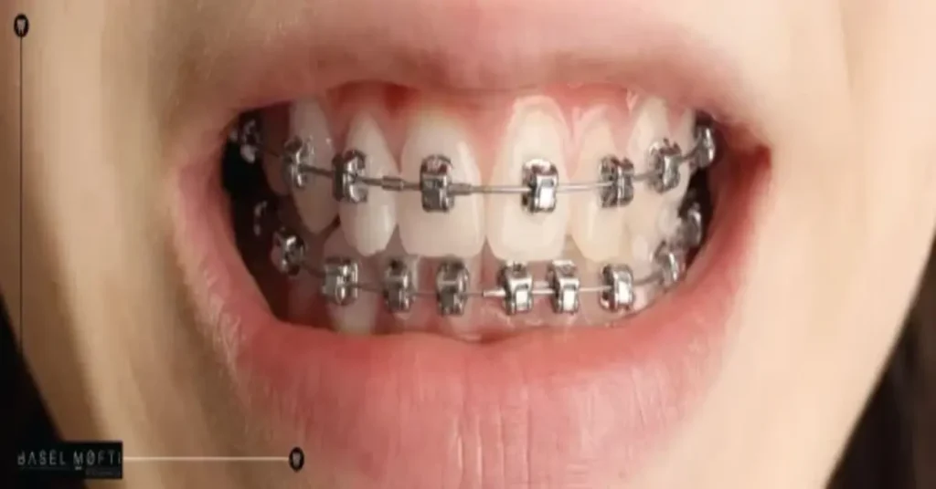 Self Ligating Braces