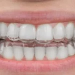 Who can get Clear Aligners in Jumeirah Dubai ?