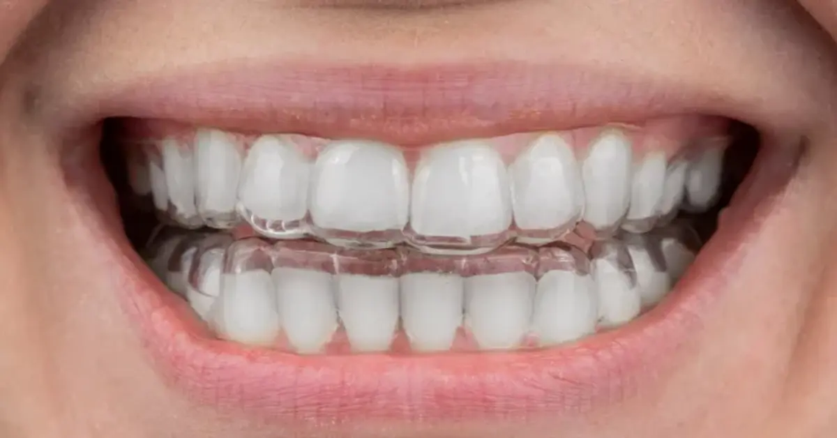 Clear Aligners in Jumeirah Dubai