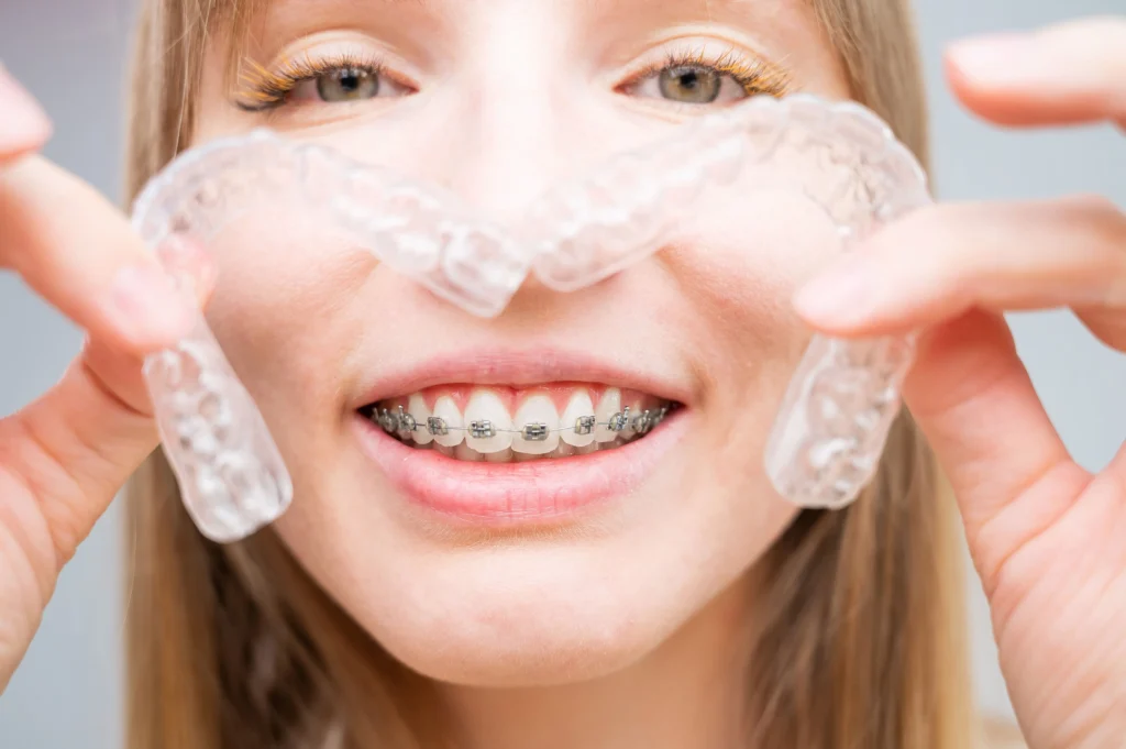 Self-Ligating Braces – The Modern Orthodontic Marvel 1 Self-Ligating Braces