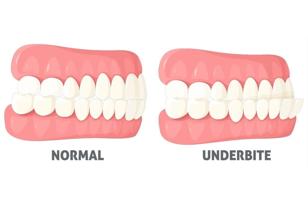 Understanding Overbite 2 Understanding Overbite