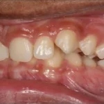 Understanding Overbite