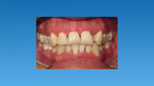 From Crossbite to Confident- The Journey to Perfect Smile 3 Posterior Crossbite