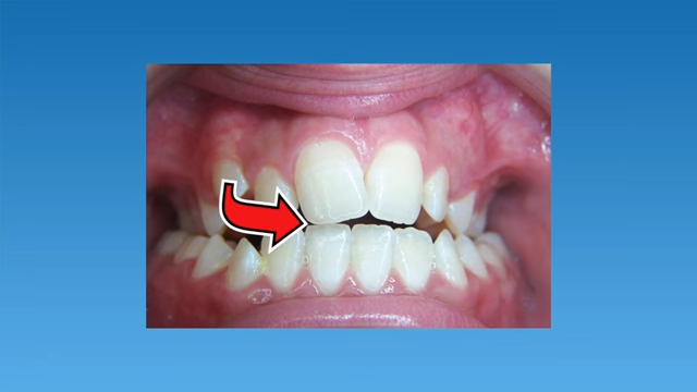 From Crossbite to Confident- The Journey to Perfect Smile 2 Anterior Crossbite